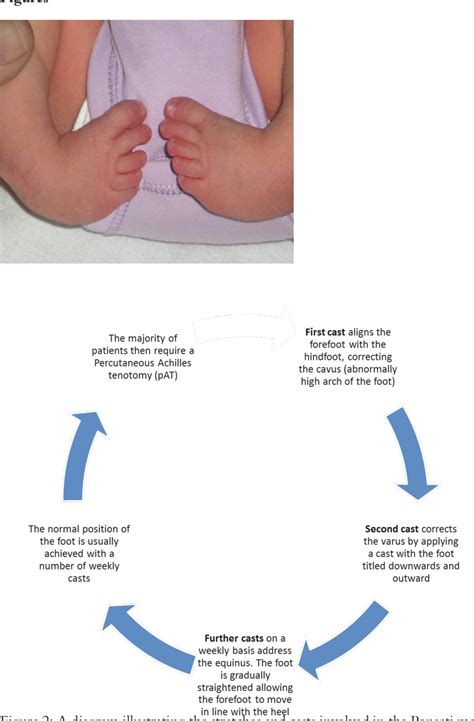 scratch test ctev|Congenital Talipes Equinovarus: Results of Treatment and Are .